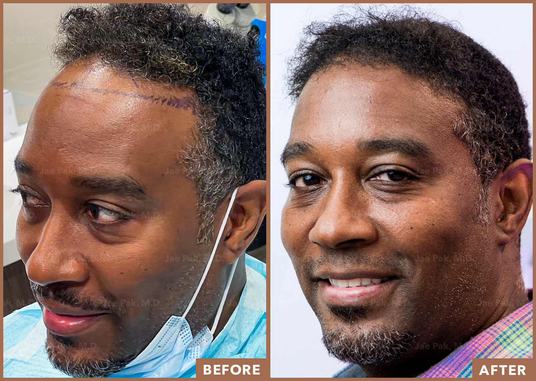 Actual Hair Transplant Patient of Jae Pak, M.D.