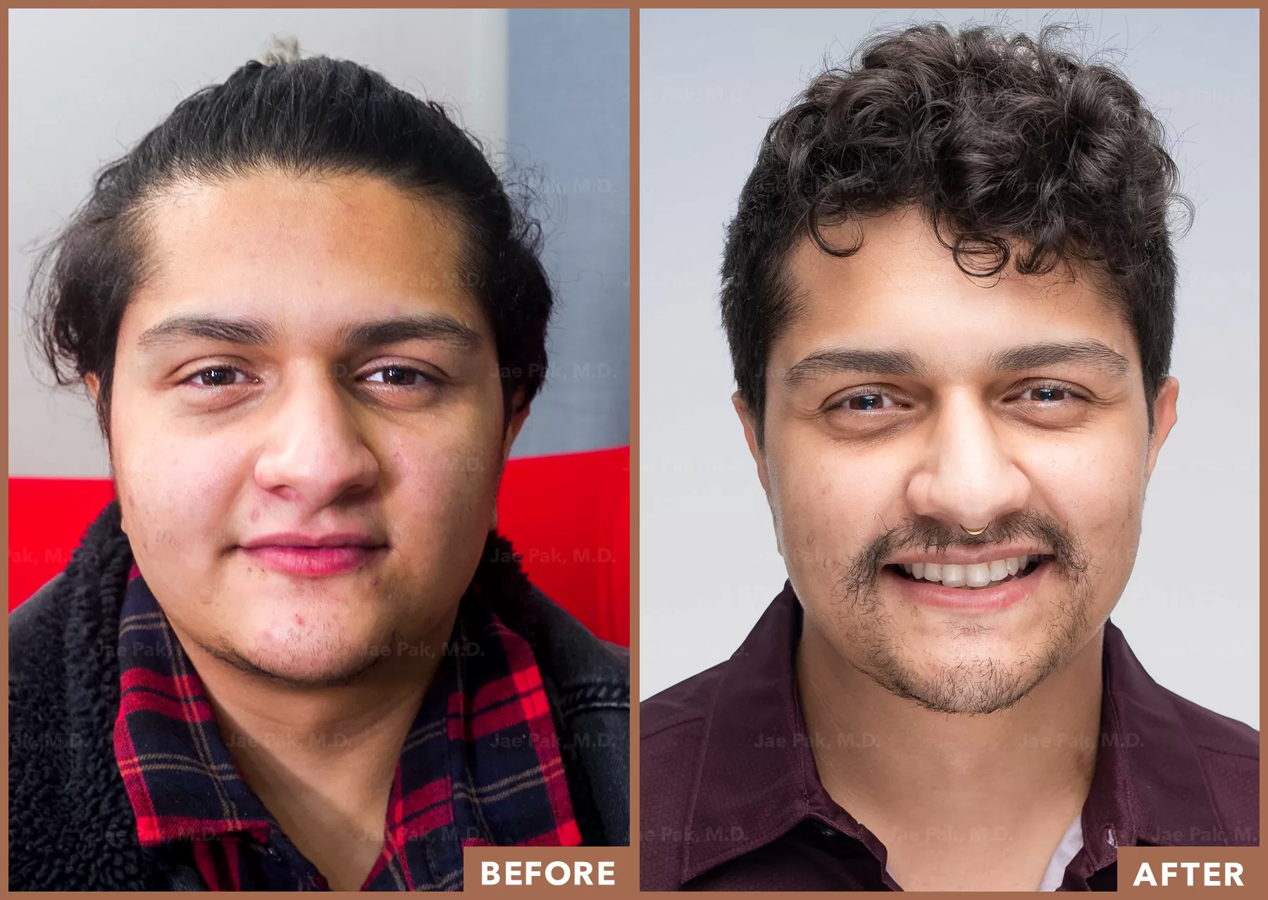 Ftm Before And After Face