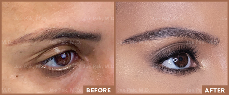 Images of a woman's eye comparing the before and after looks of her eyebrow