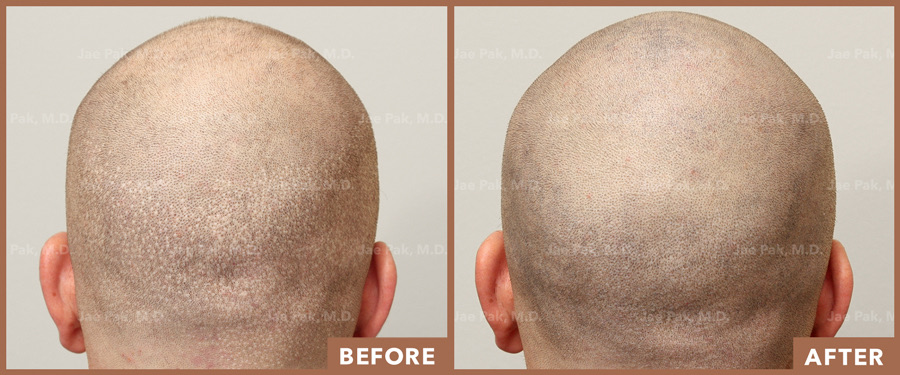 Images of man's back of. the head showing the before and the results after the hair transplant