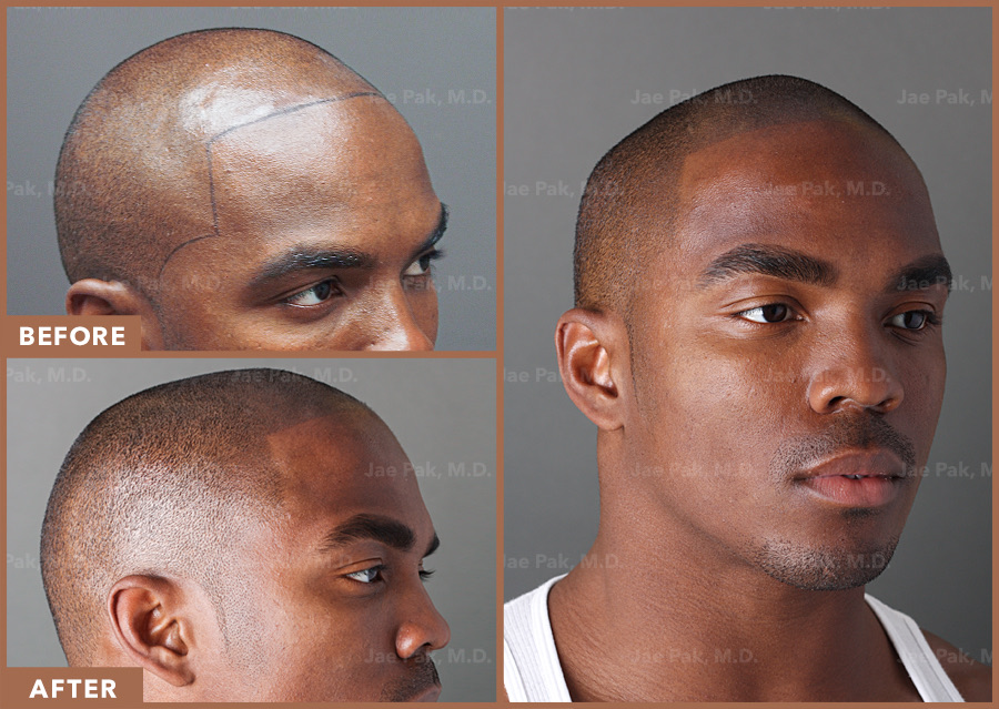 The Best Scalp Micropigmentation SMP Clinic in Lexington MA