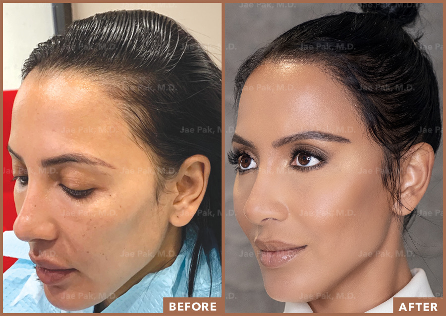 An image of a woman before her hair treatment and her ponytail look after her hairline lowering surgery