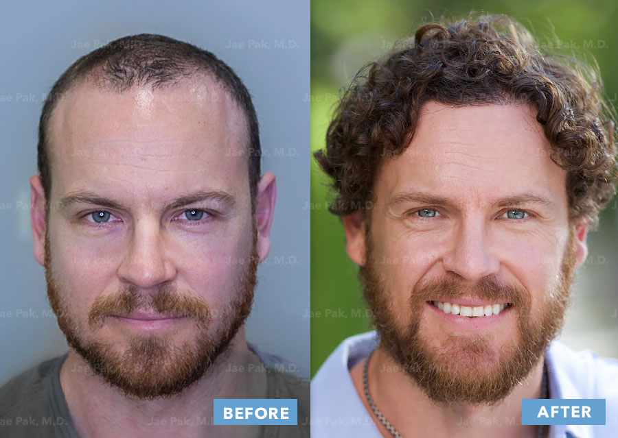 Hair Transplant Before And After What A Hair Transplant Looks