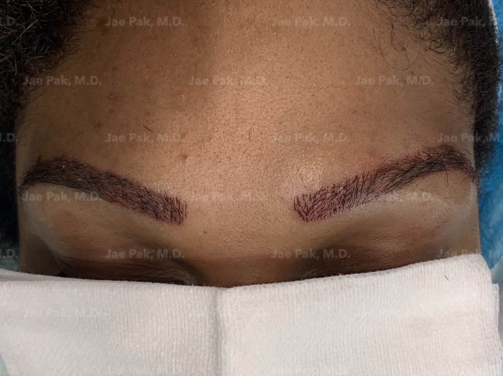 Image of a woman's eyebros after undergoing eyebrow hair transplant