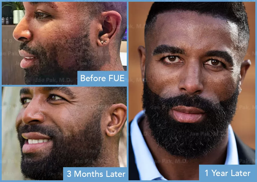 What Is A Beard Transplant Beard Style Dude