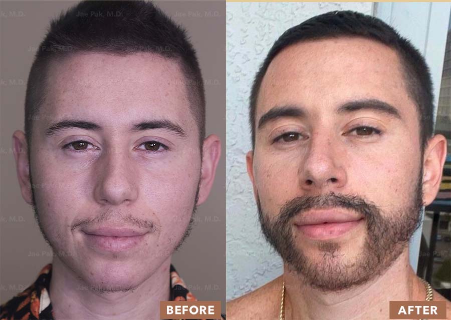 Images of a man showing the before and after beard transplant procedure