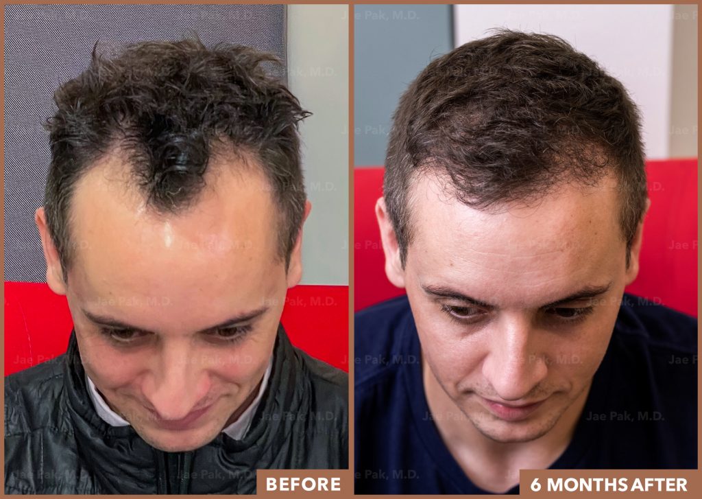 Before and After Photos of Men Who Managed Their Hair Loss—and How They Did  It
