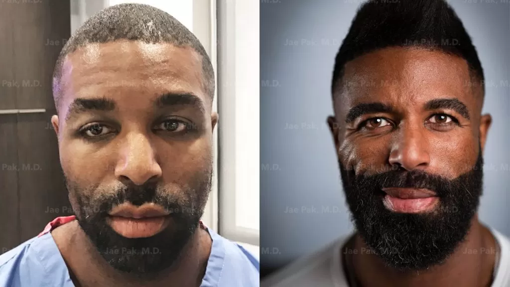 How Much Does It Cost for a Beard Transplant in Los Angeles?