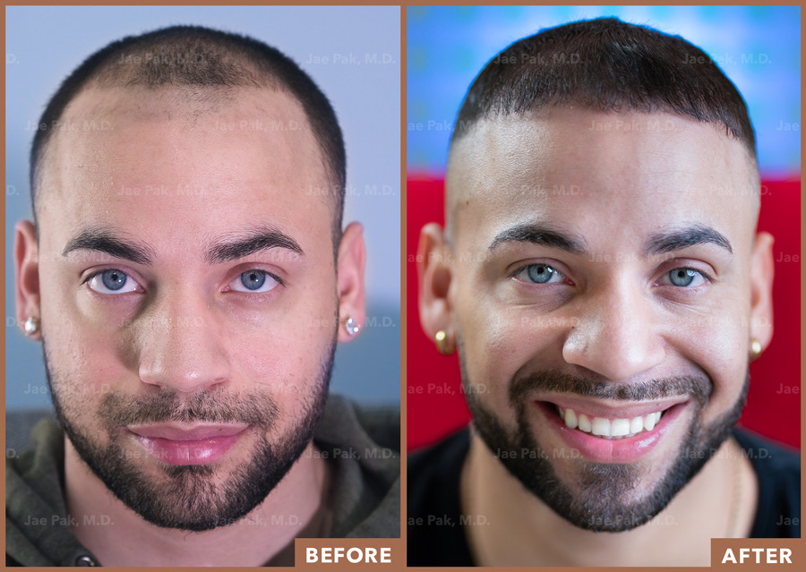 Does getting a shape up prevent (or at least help) your hairline