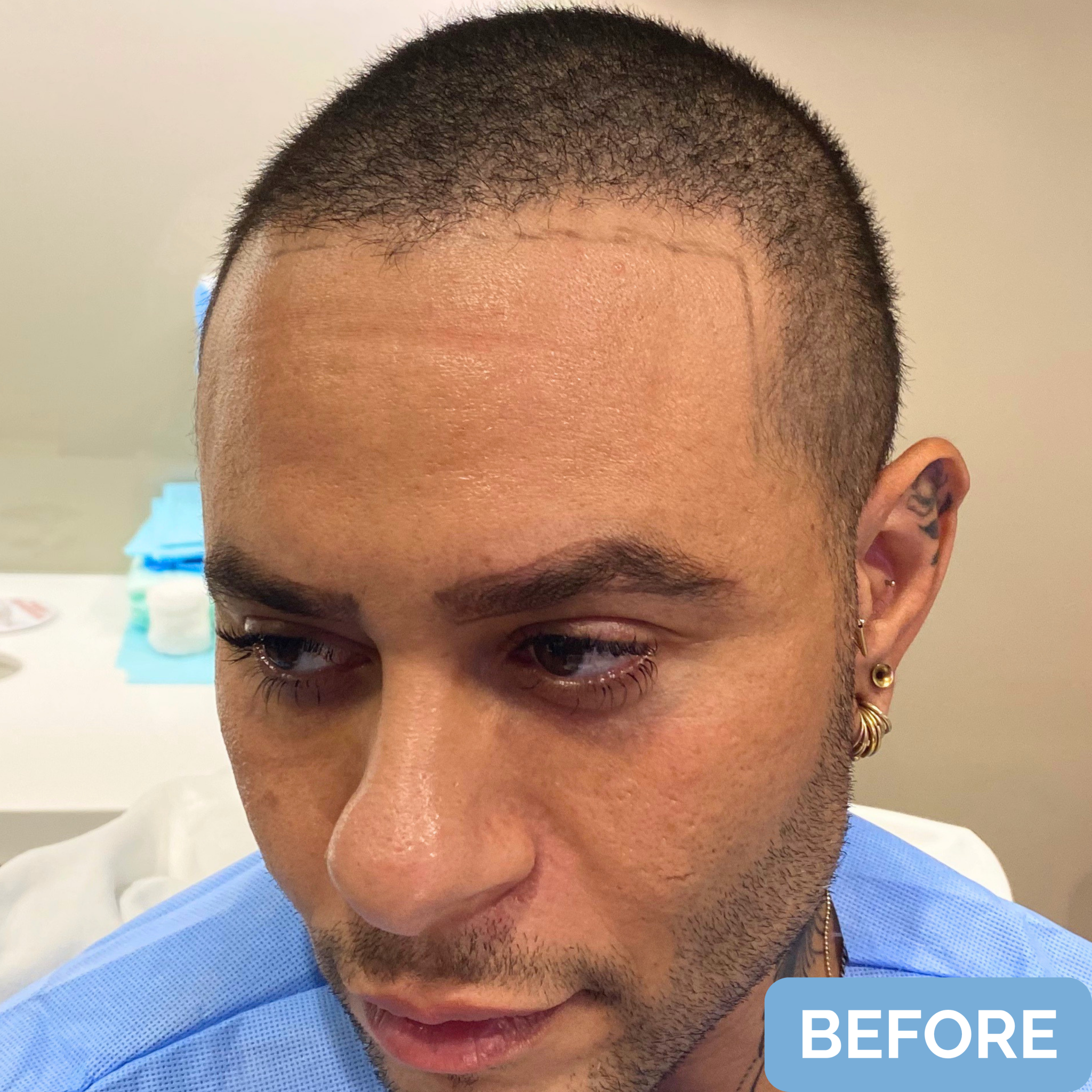 Before FUT hairline lowering— image showing right profile of a female patient with a high forehead and frontal-temporal recession, hair pulled back.