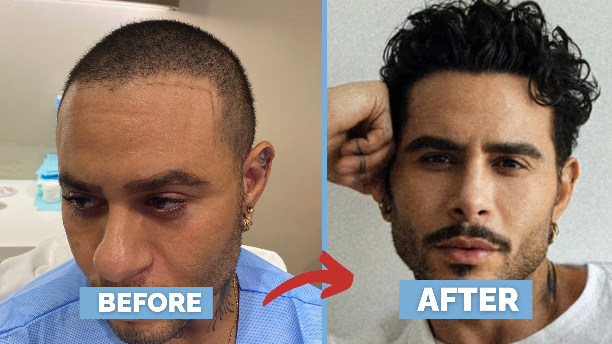 Before-and-after FUT hairline lowering — image shoring left profile of a female patient showing lowered hairline, filled temporal recession, and balanced forehead after 1,420 grafts.
