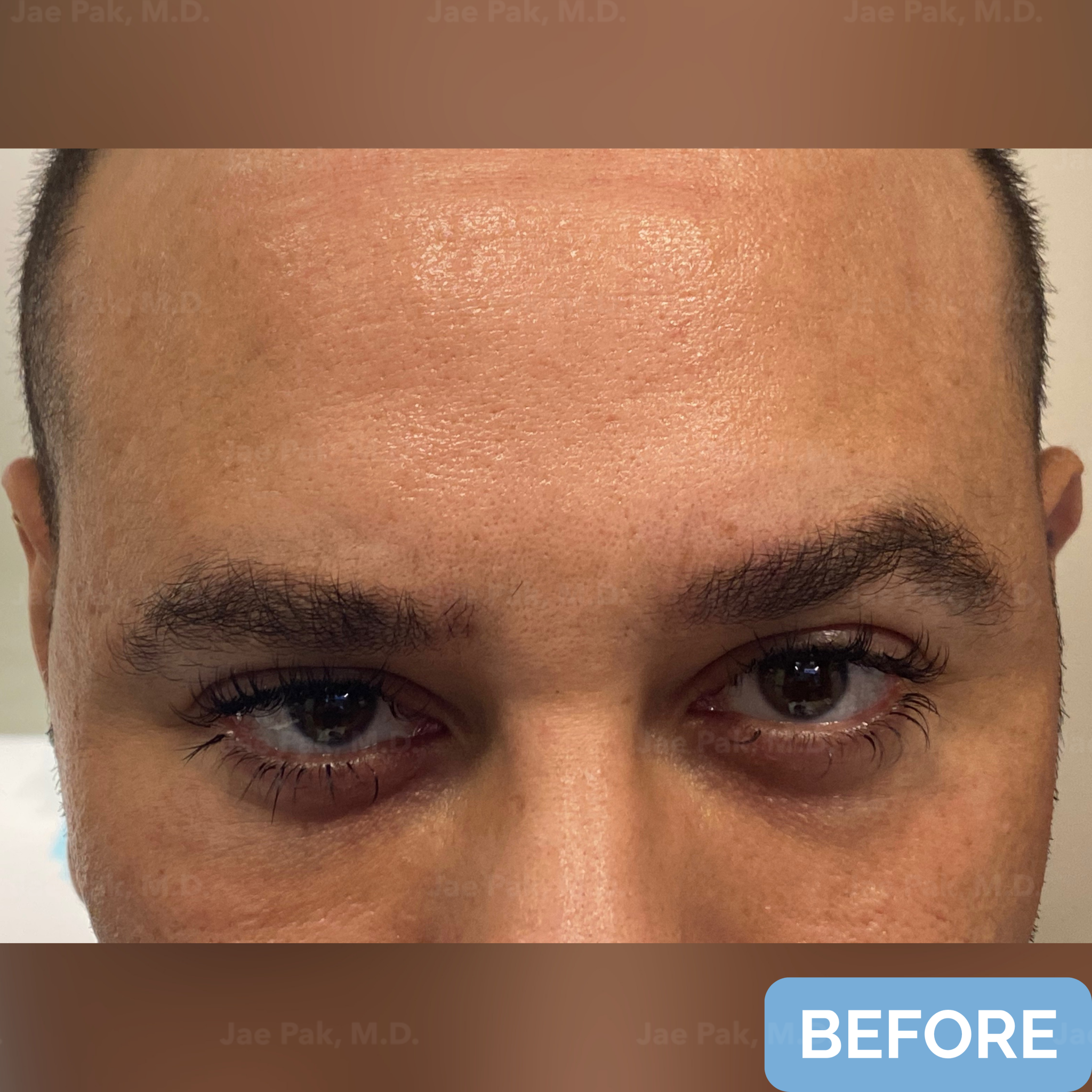 Before FUT hairline lowering— image showing top view of a female patient with a high forehead and thinning frontal hairline, wearing a headband.