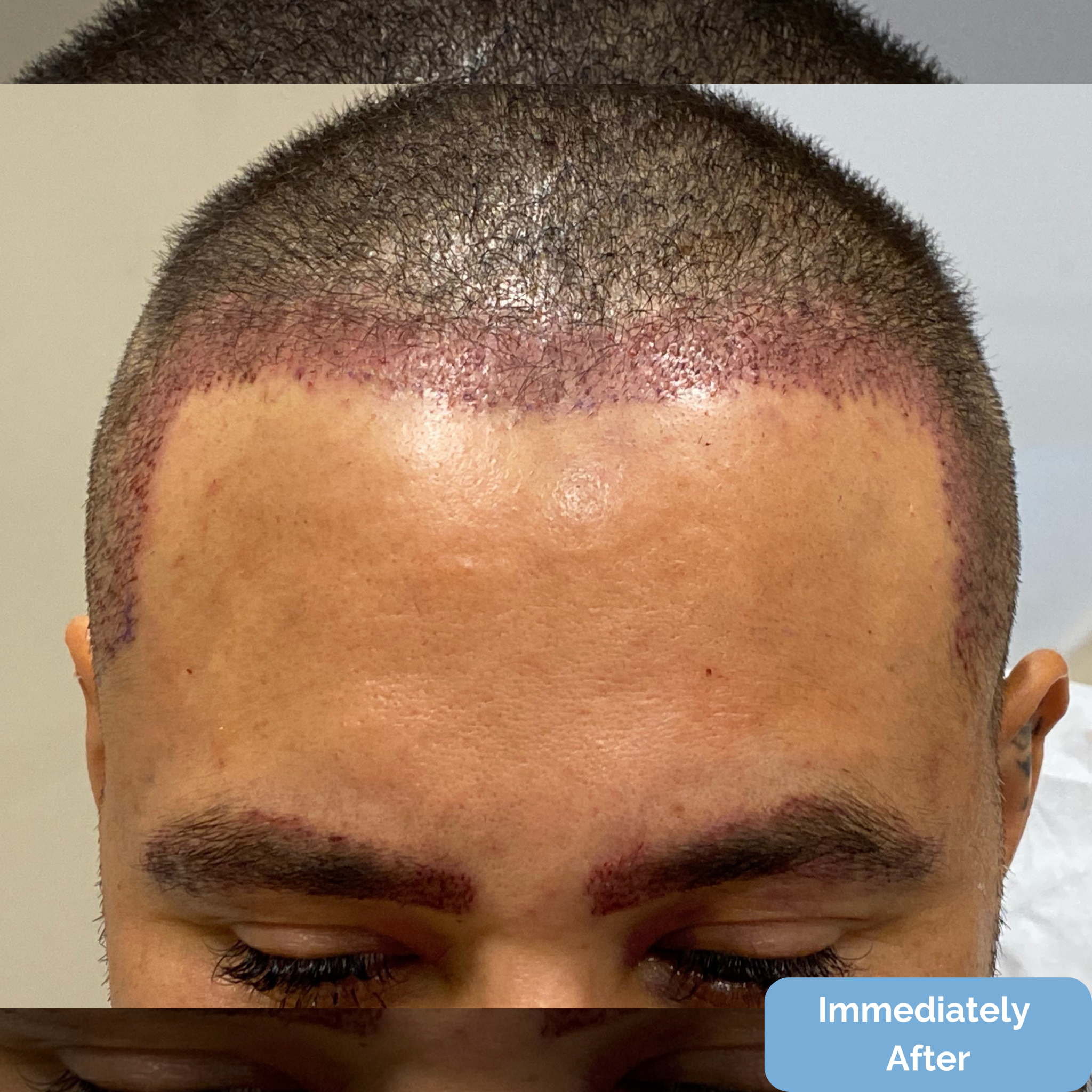 Immediately after FUT hairline lowering — image showing right profile of female patient with visible recipient sites along the new hairline following a 1,420-graft procedure.