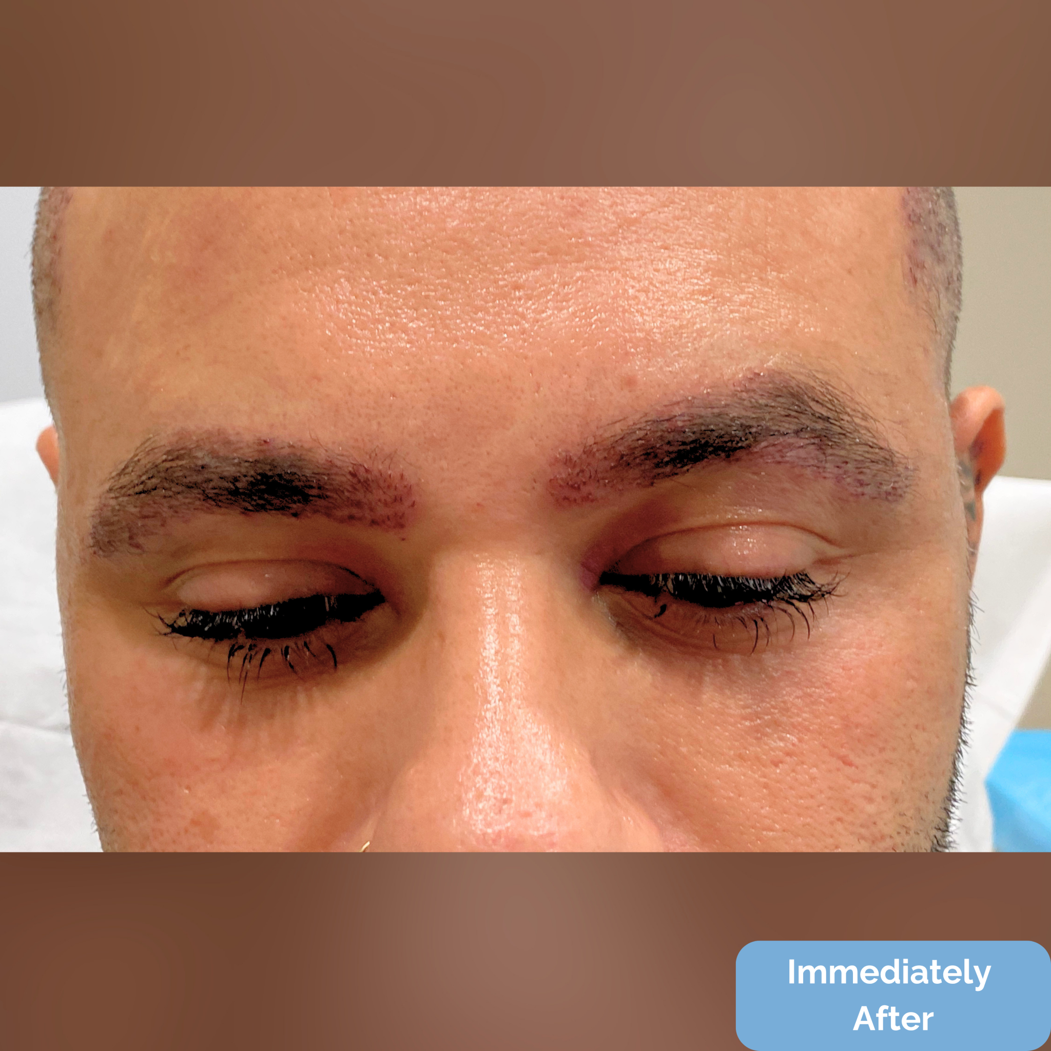 Immediately after FUT hairline lowering — image showing frontal close-up showing recipient sites and micro-irregular hairline design following a 1,420-graft procedure.