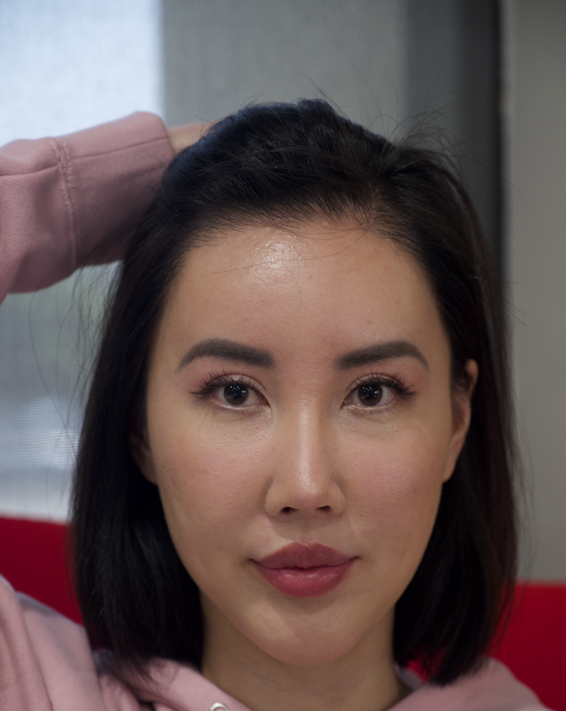 An image of Dr. Pak’s actual patient who underwent FUT hairline lowering. An internet personality shows her smile and her newly restored hairline.