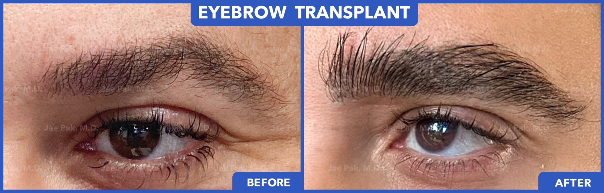 Before-and-after FUT hairline lowering — image showing frontal top-down view of a female patient showing reduced forehead height and denser frontal hairline after 1,420 grafts.