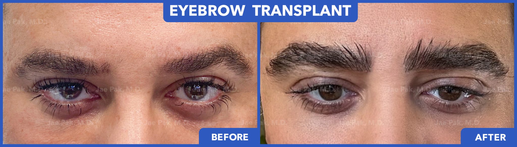 Before-and-after FUT hairline lowering — image shoring right profile of a female patient showing lowered hairline, filled temporal recession, and balanced forehead after 1,420 grafts.