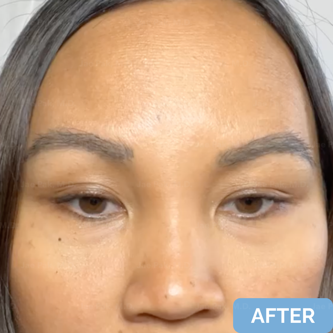 Before-and-after FUT hairline lowering — image showing frontal top-down view of a female patient showing reduced forehead height and denser frontal hairline after 1,420 grafts.