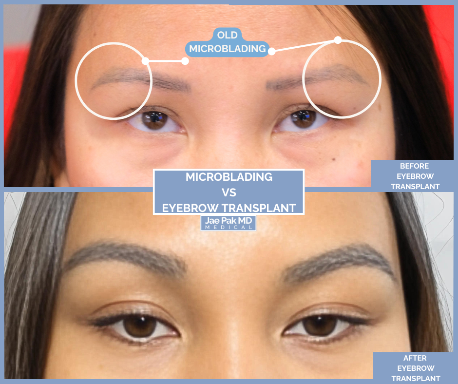 After FUT hairline lowering — an image showing a smiling female patient showing a natural, lowered hairline and balanced facial framing (1,420 grafts).