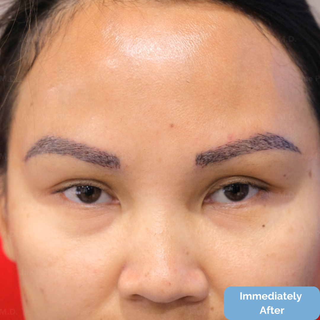 Immediately after FUT hairline lowering — image showing right profile of female patient with visible recipient sites along the new hairline following a 1,420-graft procedure.