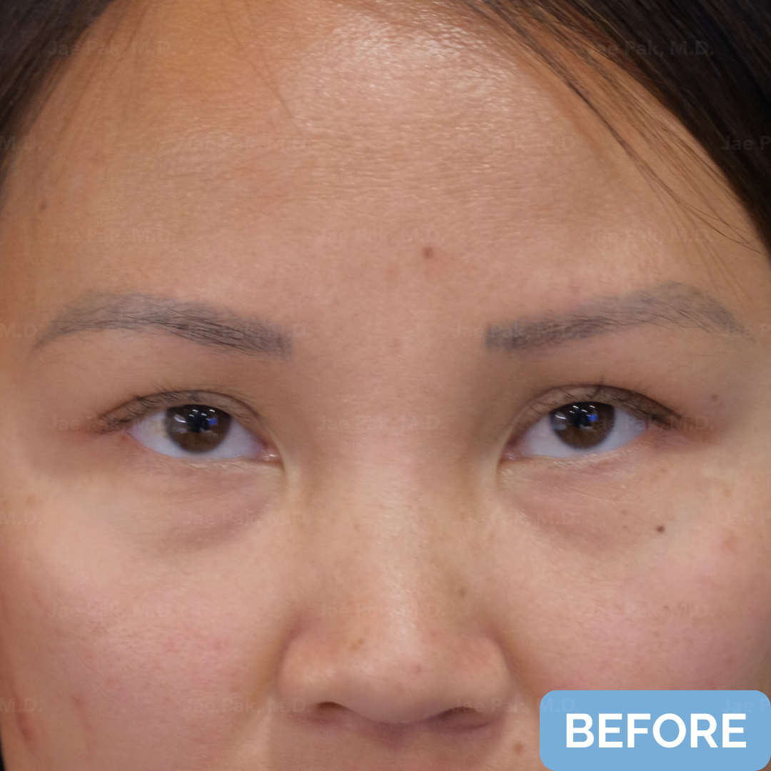 Before FUT hairline lowering— image showing right profile of a female patient with a high forehead and frontal-temporal recession, hair pulled back.