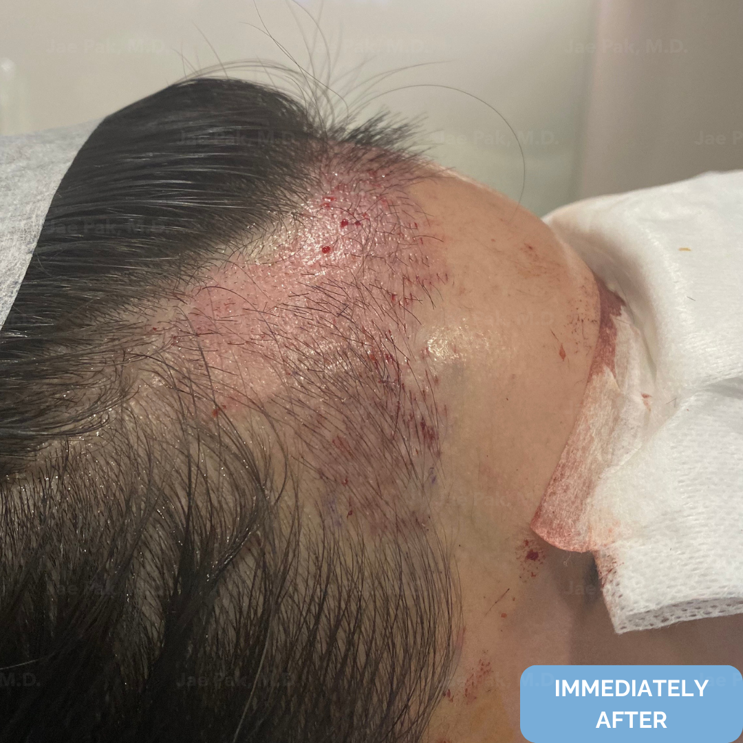 Immediately after FUT hairline lowering — image showing right profile of female patient with visible recipient sites along the new hairline following a 1,420-graft procedure.