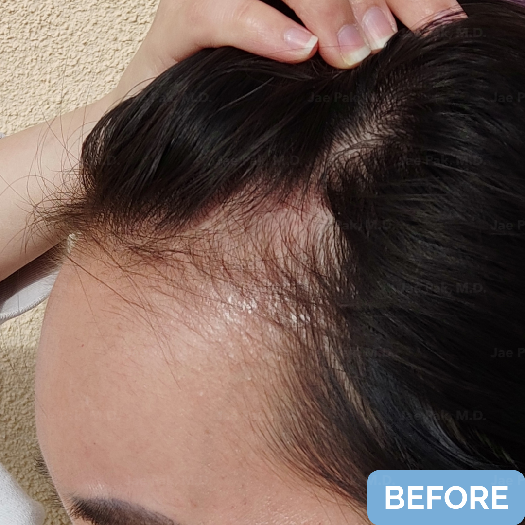 Before FUT hairline lowering— image showing top view of a female patient with a high forehead and thinning frontal hairline, wearing a headband.