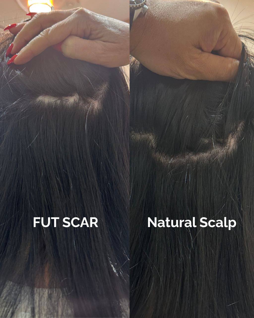 Before-and-after FUT hairline lowering — image shoring left profile of a female patient showing lowered hairline, filled temporal recession, and balanced forehead after 1,420 grafts.