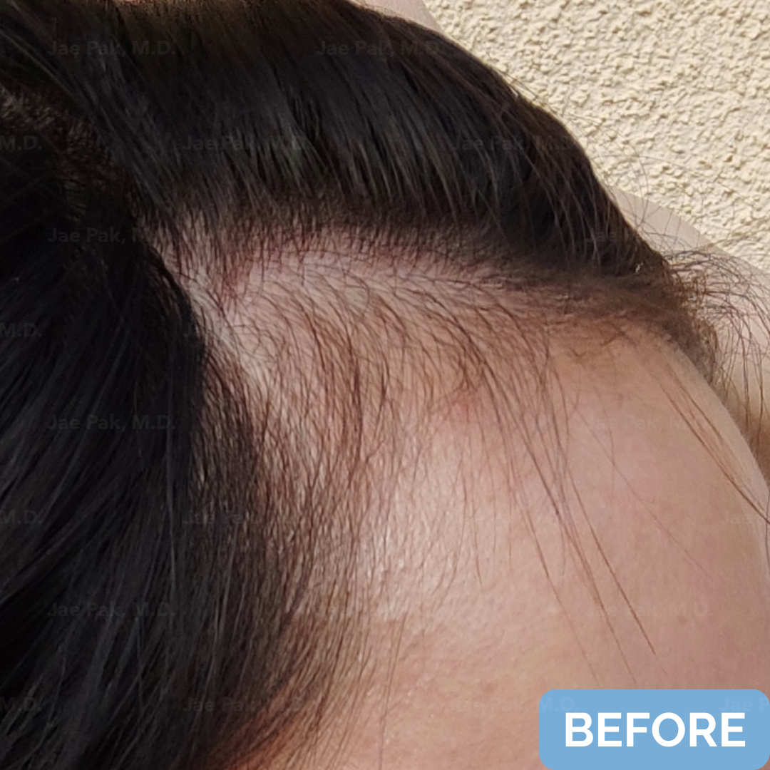 Before FUT hairline lowering— image showing right profile of a female patient with a high forehead and frontal-temporal recession, hair pulled back.