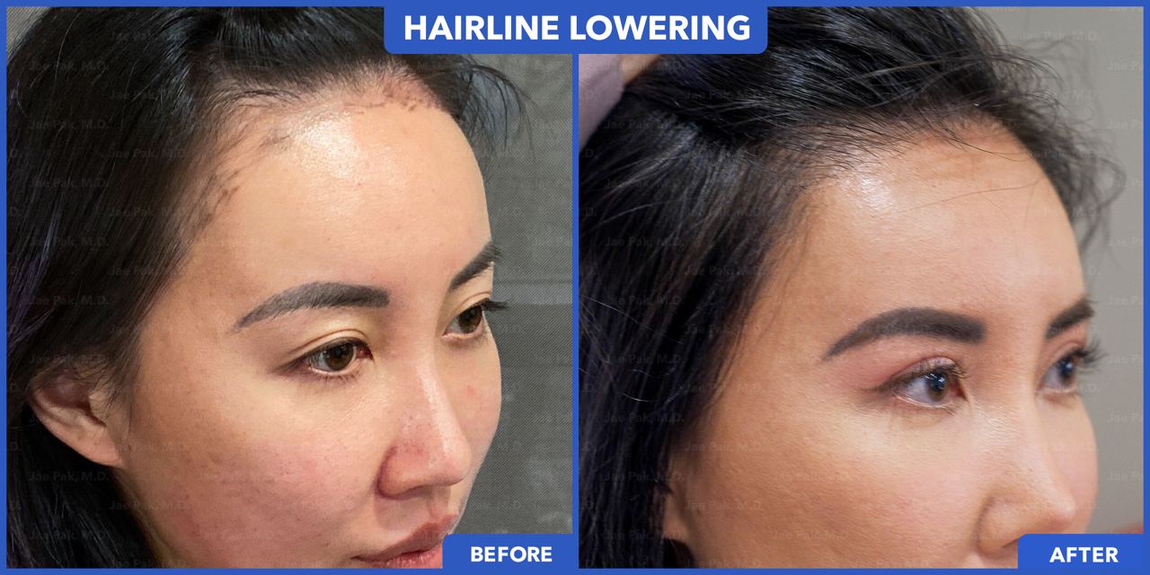 Before-and-after FUT hairline lowering — image showing frontal top-down view of a female patient showing reduced forehead height and denser frontal hairline after 1,420 grafts.