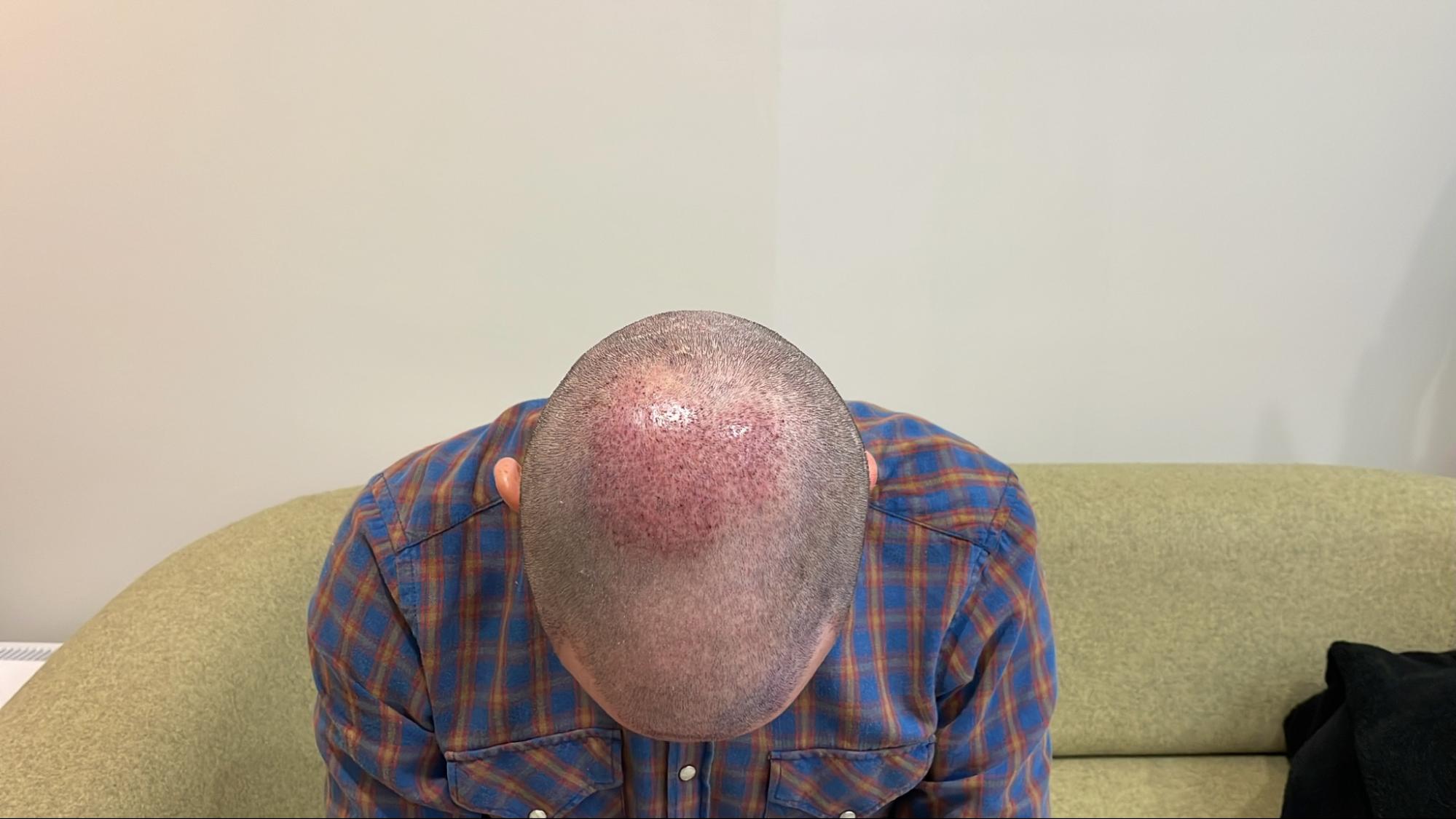 Immediately after FUT hairline lowering — image showing right profile of female patient with visible recipient sites along the new hairline following a 1,420-graft procedure.