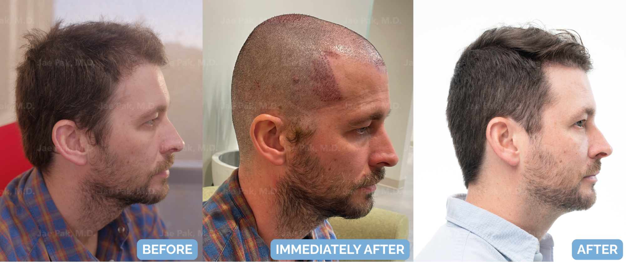 After FUT hairline lowering — an image showing a smiling female patient showing a natural, lowered hairline and balanced facial framing (1,420 grafts).