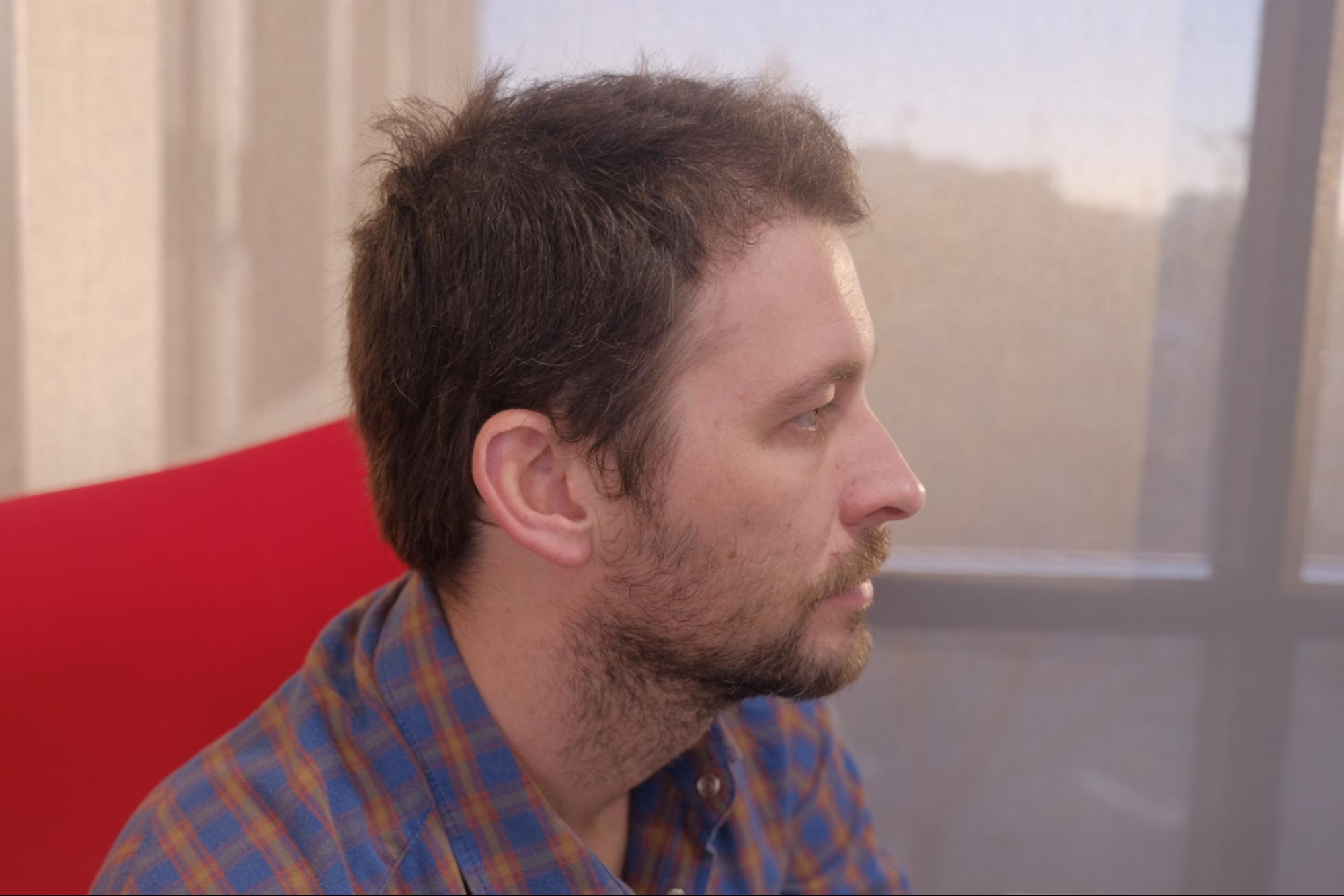 Before FUT hairline lowering— image showing right profile of a female patient with a high forehead and frontal-temporal recession, hair pulled back.