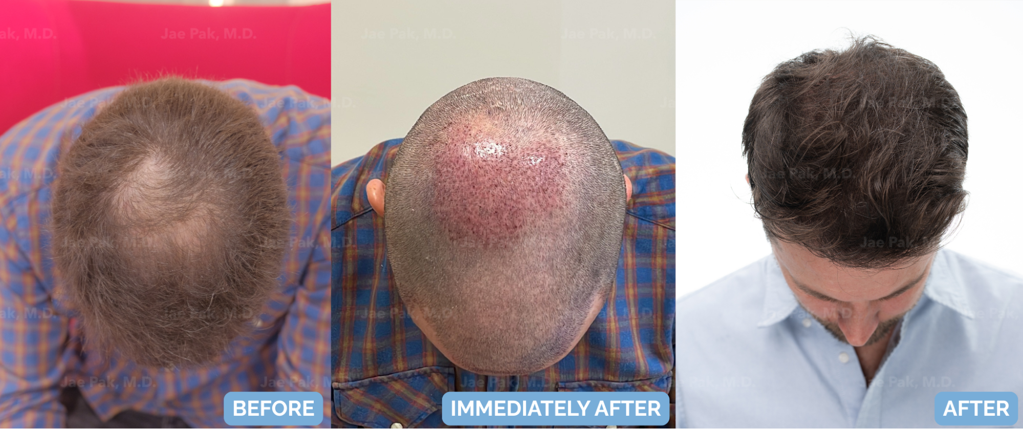 Before-and-after FUT hairline lowering — image showing frontal top-down view of a female patient showing reduced forehead height and denser frontal hairline after 1,420 grafts.