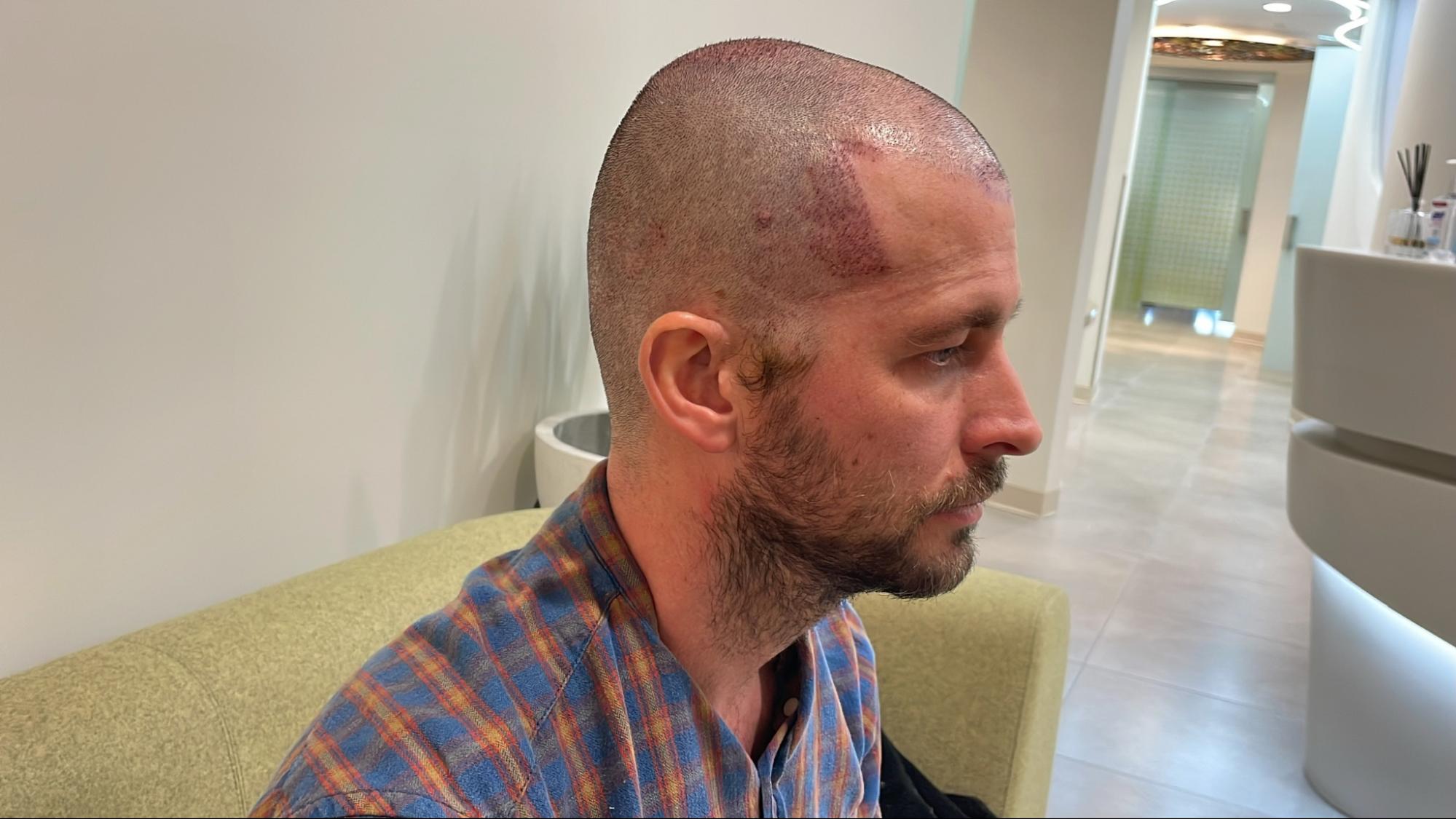 Immediately after FUT hairline lowering — image showing right profile of female patient with visible recipient sites along the new hairline following a 1,420-graft procedure.