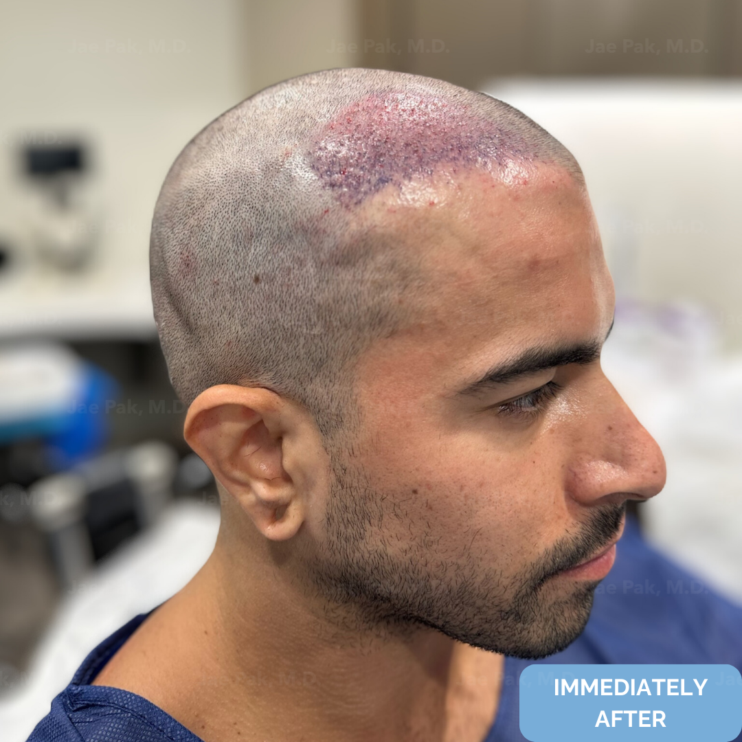 Immediately after FUT hairline lowering — image showing right profile of female patient with visible recipient sites along the new hairline following a 1,420-graft procedure.