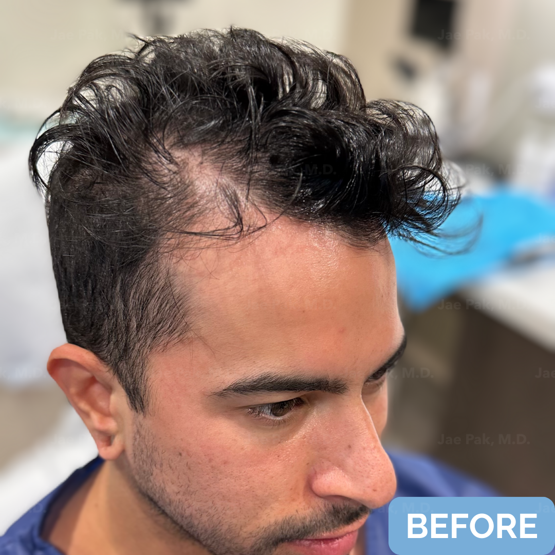 Before FUT hairline lowering— image showing right profile of a female patient with a high forehead and frontal-temporal recession, hair pulled back.