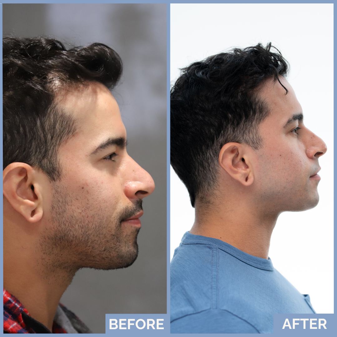 Before-and-after FUT hairline lowering — image showing frontal top-down view of a female patient showing reduced forehead height and denser frontal hairline after 1,420 grafts.