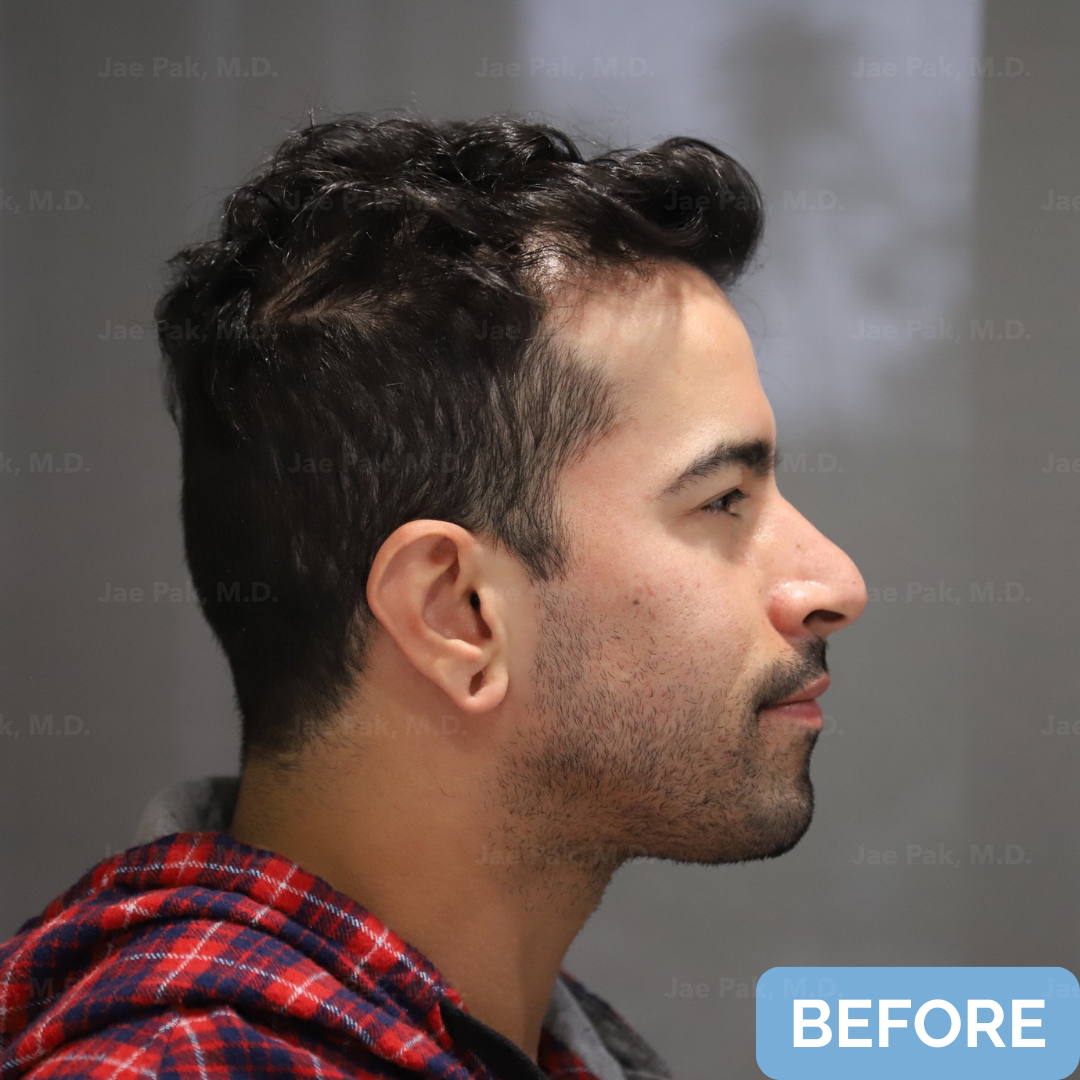 Before FUT hairline lowering— image showing right profile of a female patient with a high forehead and frontal-temporal recession, hair pulled back.